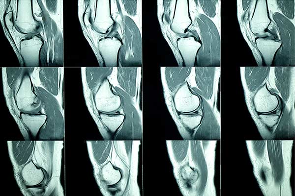 An MRI image of a knee in 360 rotation